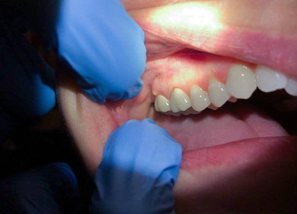 Best Dentist for Tooth Abscess  in Springville, NY